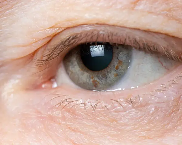 Occhio con palpebra leggermente gonfia, segno di edema oculare da stress. La pelle appare stanca, con sottili rughe e qualche ciglia spezzata.