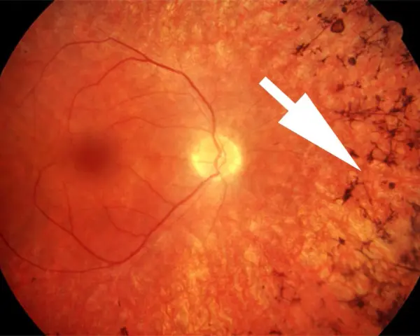 Retinite pigmentosa: sintomi visibili come depositi scuri sulla retina, indicati da una freccia bianca.