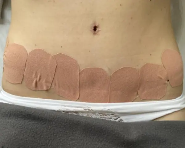 Brzuch po plastyce z widocznym obrzękiem limfatycznym, zabezpieczonym plastrami.