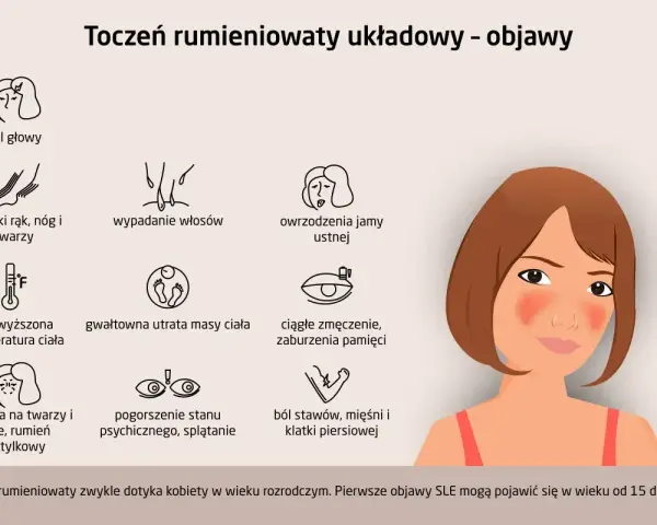 Ilustracja przedstawia objawy tocznia rumieniowatego układowego: ból głowy, obrzęki, wypadanie włosów, owrzodzenia, gorączkę, utratę wagi, zmęczenie, wysypkę motylkową, problemy ze wzrokiem i bóle stawów.