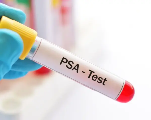 Blauer Handschuh hält Röhrchen für PSA-Test. Der PSA-Wert ist normal, was für die Gesundheit spricht.
