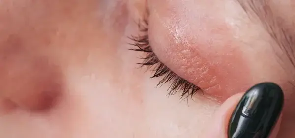 Nahaufnahme eines Auges mit roten Augenlidern, die auf eine Mangelerscheinung hindeuten. Eine dunkle Nagelspitze berührt sanft die Haut.