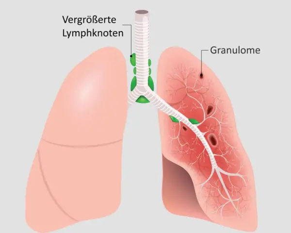 Lunge mit vergrößerten Lymphknoten und Granulomen, typische Sarkoidose-Symptome.