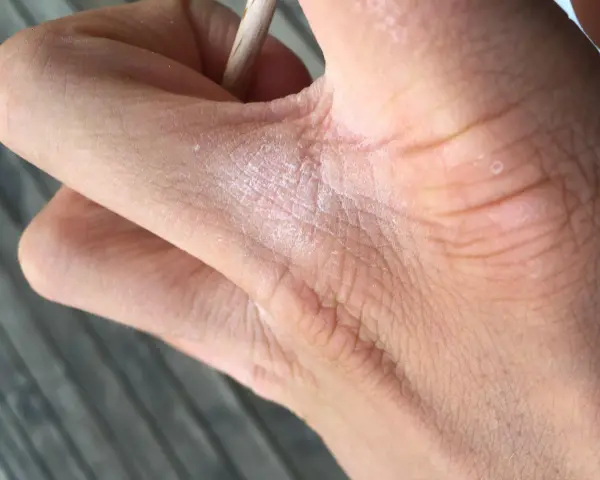 När huden är torr mellan fingrarna kan det kännas obekvämt. Här syns en närbild på en hand med torr hud och lite vita flingor.