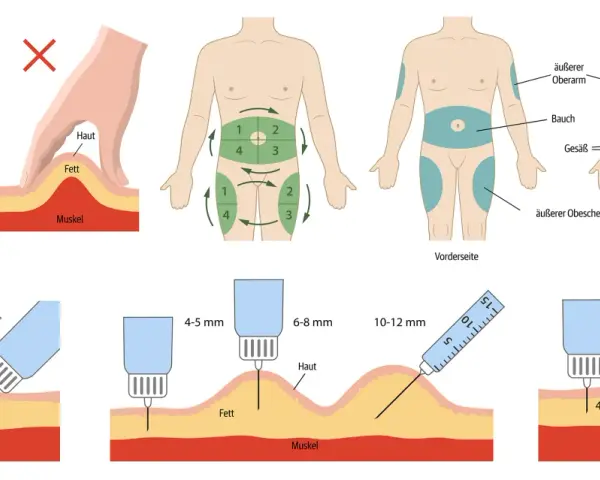 Anleitung: wie spritze ich Insulin richtig in den Oberschenkel. Zeigt Hautfalte, Injektionswinkel (90°/45°), Nadellänge und Körperstellen.