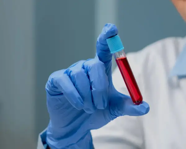 Ręka w niebieskiej rękawiczce trzyma probówkę z czerwoną cieczą. To może być próbka do badań, np. PDW co to jest, czyli wskaźnik anizocytozy płytek krwi.