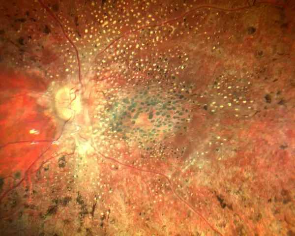 Retina con pigmentazione irregolare e vasi sanguigni, indicativa di amaurosi congenita di Leber. Ricerca di nuove cure in corso.