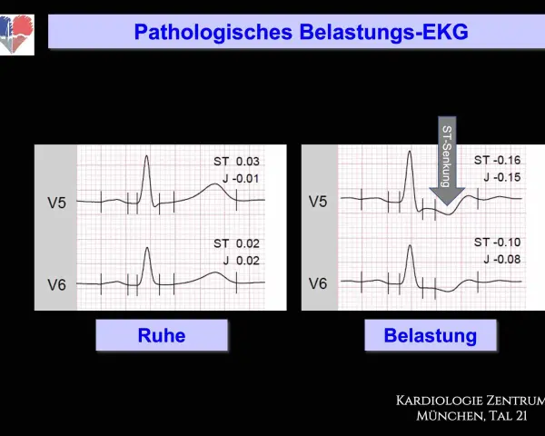 Vergleich von EKG-Aufzeichnungen in Ruhe und unter Belastung. Das Belastungs-EKG zeigt eine ST-Senkung, was auf pathologische Veränderungen hinweist.