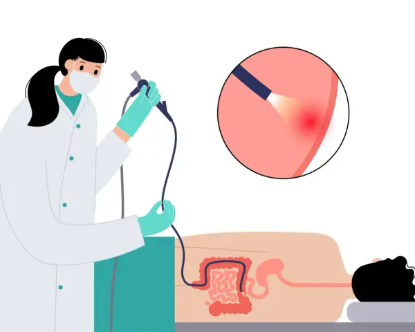 Arzt führt Darmspiegelung durch. Eine Lupe zeigt eine Entzündung im Darm. Warum nicht duschen vor Darmspiegelung? Hygiene ist wichtig.