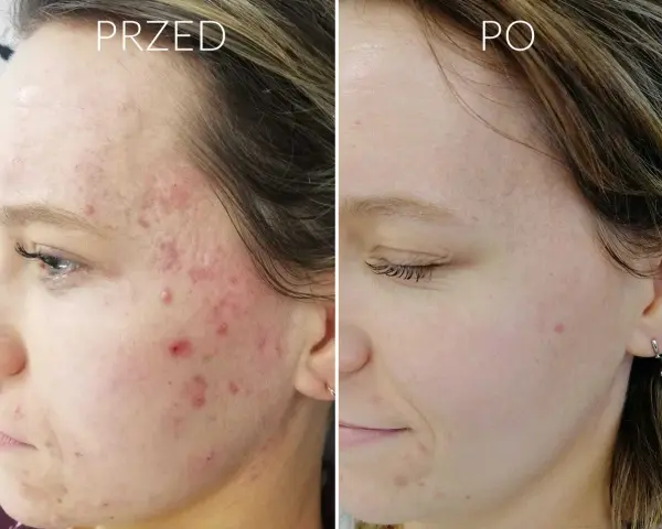 Jak skutecznie pozbyć się pryszcza z ropą i uniknąć blizn