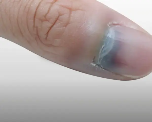 Gros plan sur un pouce avec un ongle bleu, signe d'un choc ou d'une ecchymose sous l'ongle.
