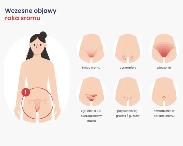Wczesne objawy raka sromu: świąd, pieczenie, dyskomfort, zgrubienia, grudki, owrzodzenia. Zwróć uwagę na zmiany.