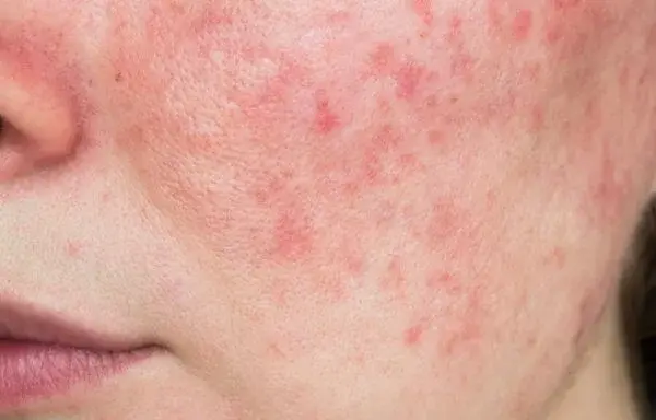 Gerötete Gesichtshaut: Ursachen, Symptome und effektive Behandlungsmöglichkeiten