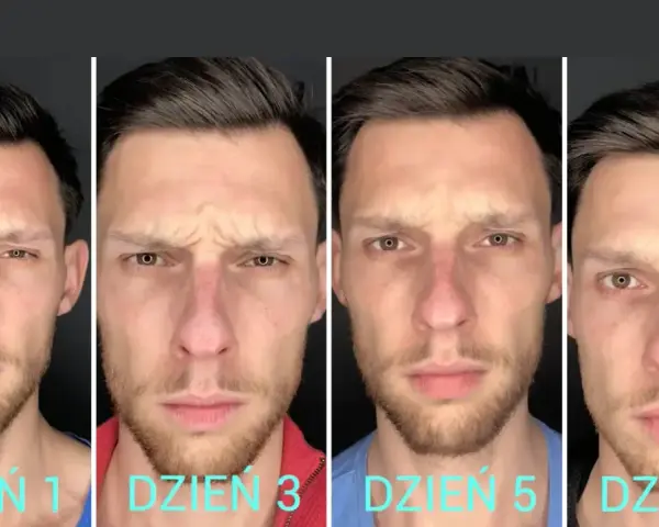 Cztery zbliżenia twarzy mężczyzny pokazujące redukcję lwiej zmarszczki w ciągu 7 dni.