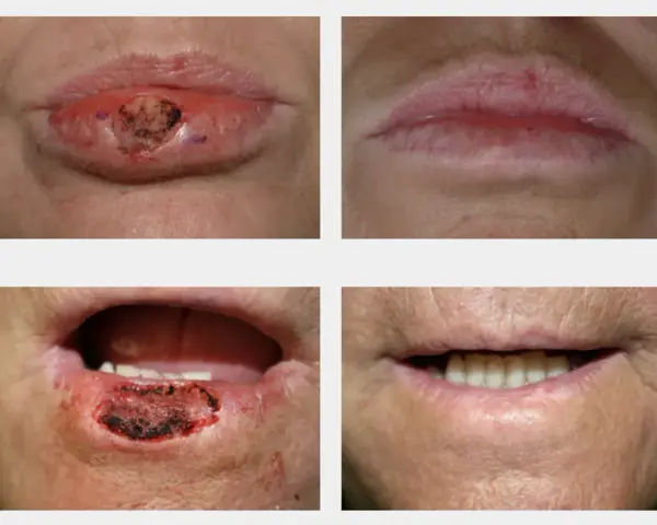 Prima e dopo il trattamento di una lesione labiale. Non si tratta di schiacciare punti neri sulle labbra, ma di una cura medica.