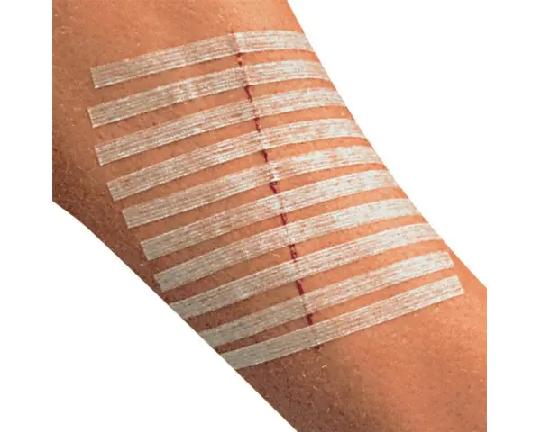 Rana na przedramieniu zabezpieczona plastrami zamiast szwów. Delikatne paski przytrzymują skórę, przyspieszając gojenie.