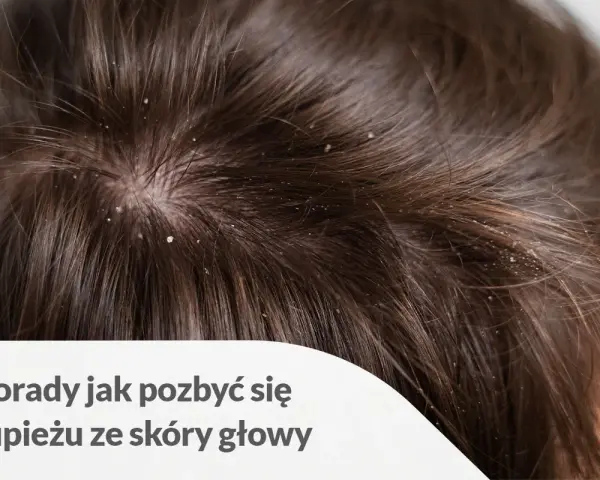 Łupież na skórze głowy, spowodowany przez Malassezia. Domowe sposoby na jego zwalczanie.