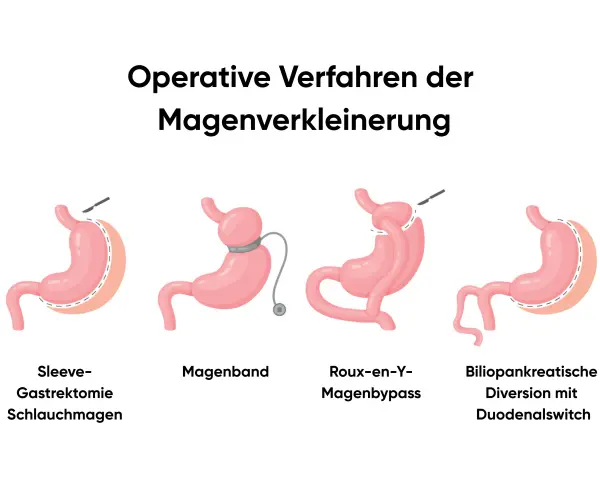 Illustrationen zeigen operative Verfahren zur Magenverkleinerung, darunter ein Magenbypass.