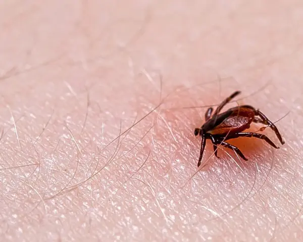 Makro zbliżenie na kleszcza wbitego w ludzką skórę, widoczne drobne włoski i tekstura naskórka.