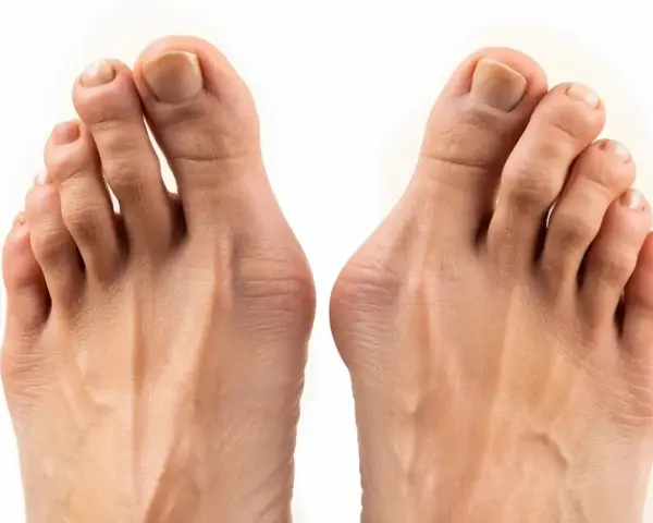 Två fötter med tydlig hallux valgus inflammation vid stortålederna.