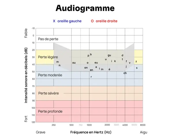 Audiogramme montrant les résultats d'un test auditif. Les zones indiquent le niveau de perte auditive, de "Pas de perte" à "Perte profonde", en fonction de la fréquence et de l'intensité sonore. Ce graphique est essentiel pour évaluer l'audition à tout...