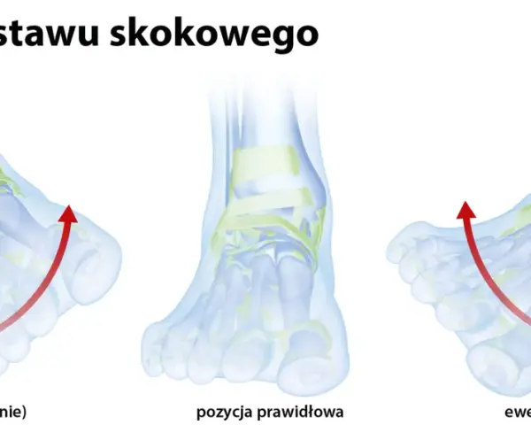 Ilustracja pokazuje inwersję stopy, czyli odwrócenie, które prowadzi do uszkodzenia więzadła skokowo-strzałkowego. Obok prawidłowa pozycja i ewersja.