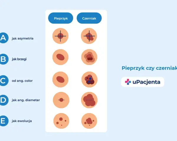 Porównanie cech pieprzyka i czerniaka: asymetria, brzegi, kolor, średnica i ewolucja.