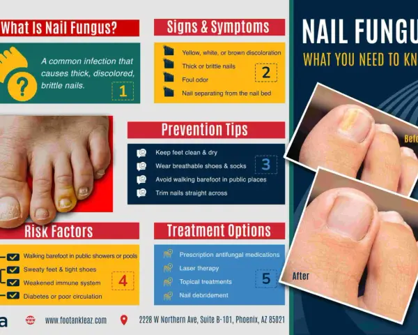 Infographie sur le vernis mycose : causes, symptômes, prévention et traitements. Avant/après montrant l'amélioration d'un ongle atteint.