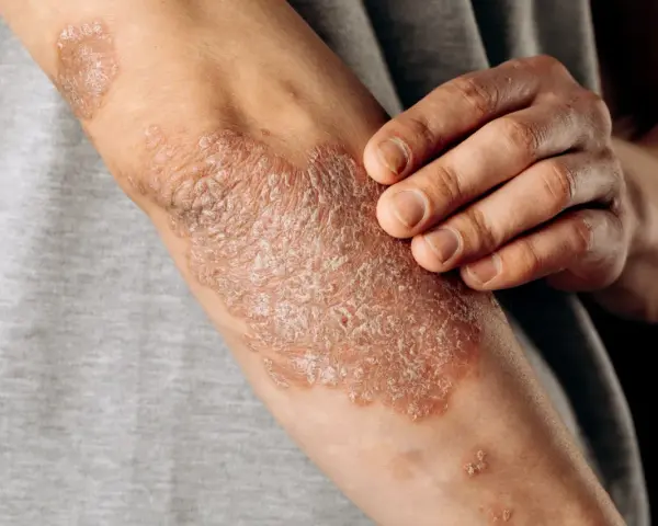 Psoriasis en los codos, con parches escamosos y enrojecidos. Una mano toca suavemente la piel afectada.