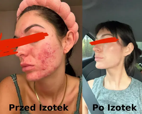 Przed i po kuracji Izotekiem: skóra z trądzikiem i bliznami przechodzi transformację w gładką cerę.