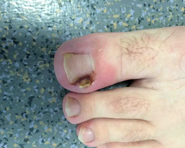 Gros plan sur un ongle de pied présentant un problème d'infection fongique, avec une partie de l'ongle décolorée et abîmée.