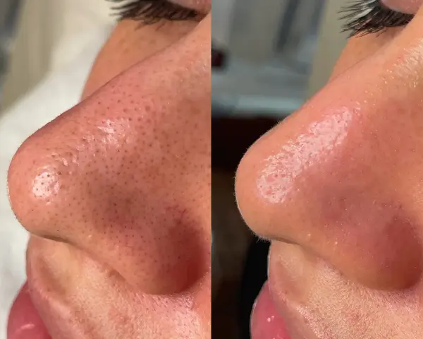 Antes y después de un Hydrafacial: la piel del rostro luce más limpia y luminosa, con poros menos visibles.