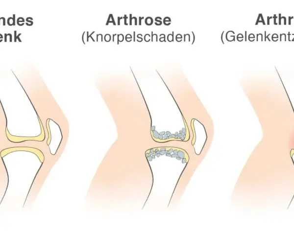 Vergleich von Gelenken: gesund, Arthrose (Knorpelschaden) und Arthritis (Gelenkentzündung). Arthritis zeigt eine Entzündung im Gelenk.