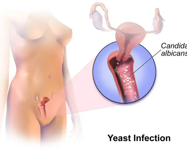 Illustration of a yeast infection in the vagina, showing Candida albicans.
