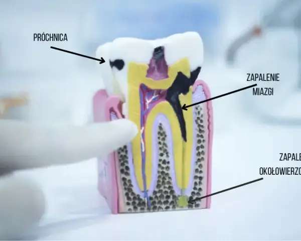 Boli ząb, nie wiesz który? Jak dentysta precyzyjnie znajdzie przyczynę