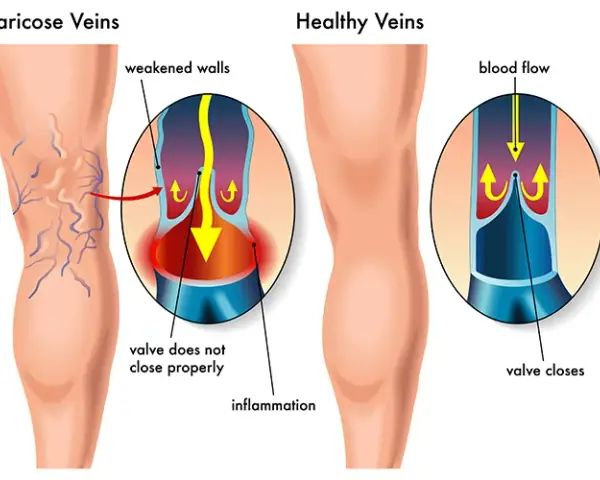 Bein Thrombose Symptome: Warnsignale erkennen & richtig handeln