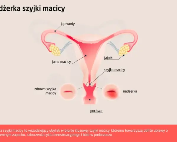Ilustracja przedstawia budowę narządów rodnych kobiety z zaznaczoną nadżerką szyjki macicy. Obok zdrowej szyjki macicy widoczna jest nadżerka.
