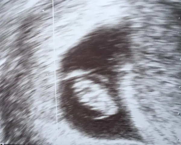 Ultraschallbild zeigt einen frühen Embryo. Die Ramzi-Methode könnte hier angewendet werden, um das Geschlecht zu erraten.