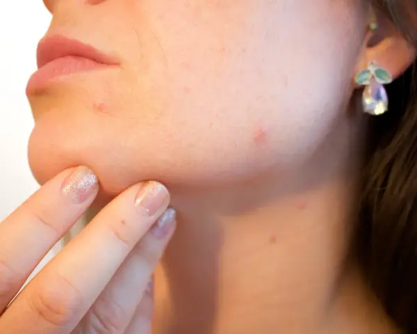 Dita con unghie glitterate toccano il mento, evidenziando imperfezioni. Un primo piano che mostra la volontà di smacchiare pelle e ottenere un incarnato uniforme.