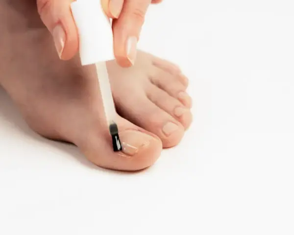 Application d'une huile essentielle sur un ongle incarné pour soulager la douleur et favoriser la guérison.