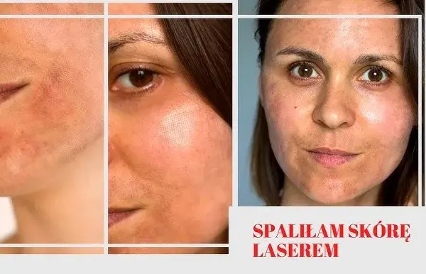 Jak długo goi się skóra po laserze frakcyjnym? Czas regeneracji