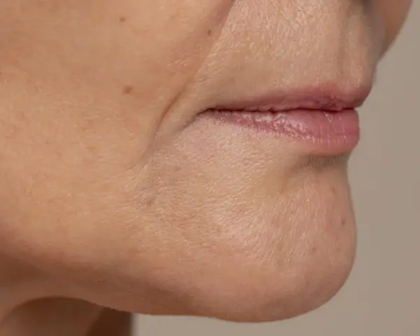 Primer plano de la zona de la barbilla y boca, mostrando la flacidez facial a los 40 y algunas pecas.