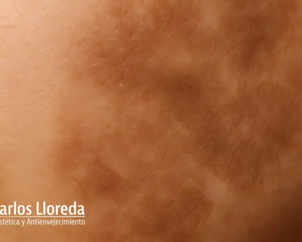Piel con manchas irregulares, indicativo de hiperpigmentación postinflamatoria.