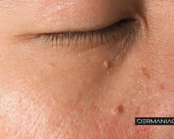 Primer plano de la piel del rostro con varias verrugas, mostrando la textura y el detalle de la piel. La imagen sugiere la necesidad de quitar verrugas cara.