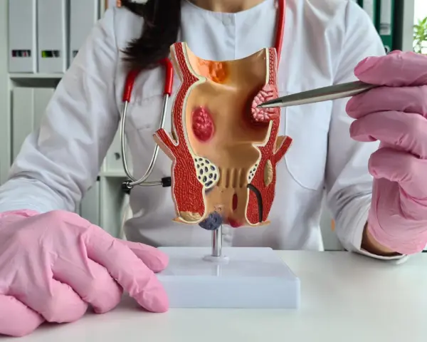 Model jelita grubego z widocznymi hemoroidami, często pojawiającymi się po porodzie. Lekarz w różowych rękawiczkach wskazuje na problem.