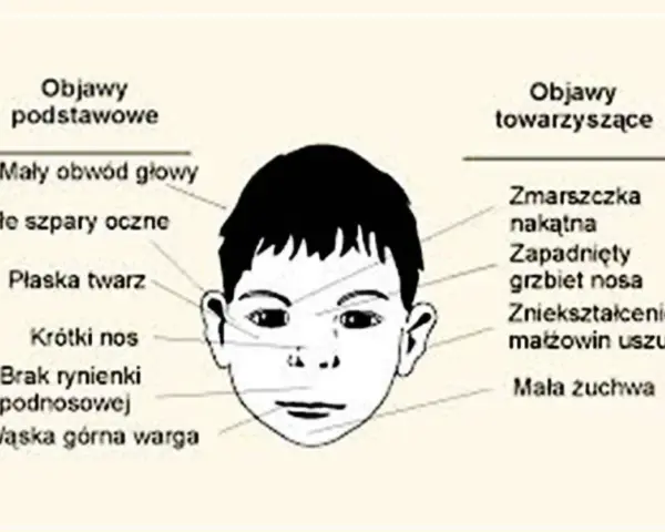 Ilustracja twarzy dziecka z opisem objawów. Co to znaczy? Mały obwód głowy, płaska twarz, krótki nos, wąska warga, zmarszczka nakątna, zapadnięty grzbiet nosa.