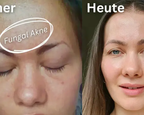 Vorher: Haut mit Rötungen und Pickelchen, gekennzeichnet als "Fungal Akne". Heute: Klare, strahlende Haut.