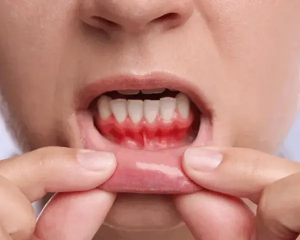 Co na bolące dziąsło? Ulga, przyczyny i porady eksperta.
