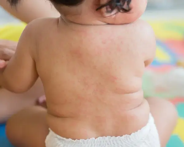 Roter Ausschlag auf dem Rücken eines Babys, möglicherweise nach drei Tagen Fieber.