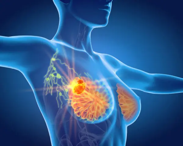 Anatomical illustration of a female torso showing breast tissue and lymph nodes, with a highlighted area indicating a potential issue.